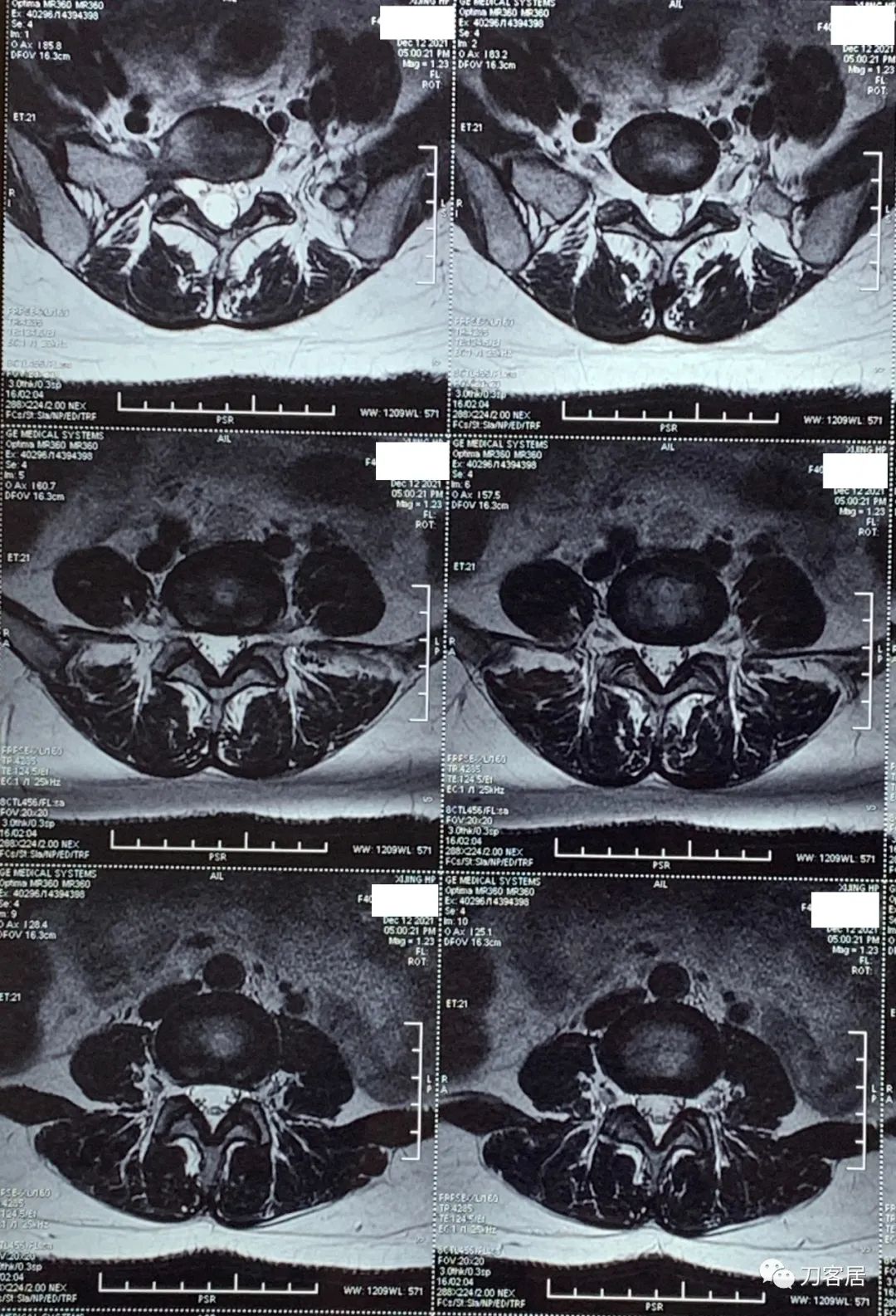 50多岁女性剧烈腰痛,40岁女人腰痛是什么原因引起的