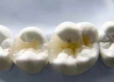 广州哪家医院看牙比较实惠,广州三甲医院种牙齿多少钱一颗