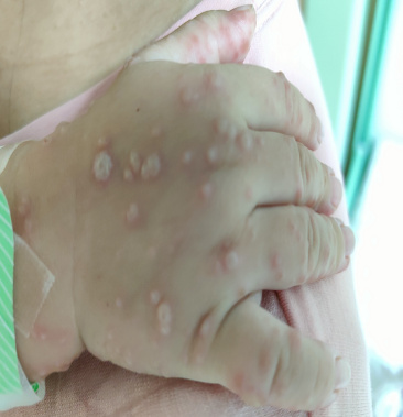 宝宝健康学堂全集,宝宝病毒感染嘴巴手脚里面长疱疹