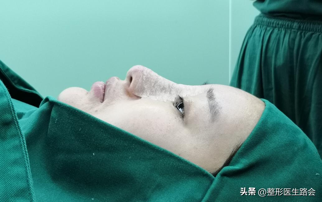 硅胶隆鼻后鼻尖发红怎么回事,单纯硅胶隆鼻一分钟搞定