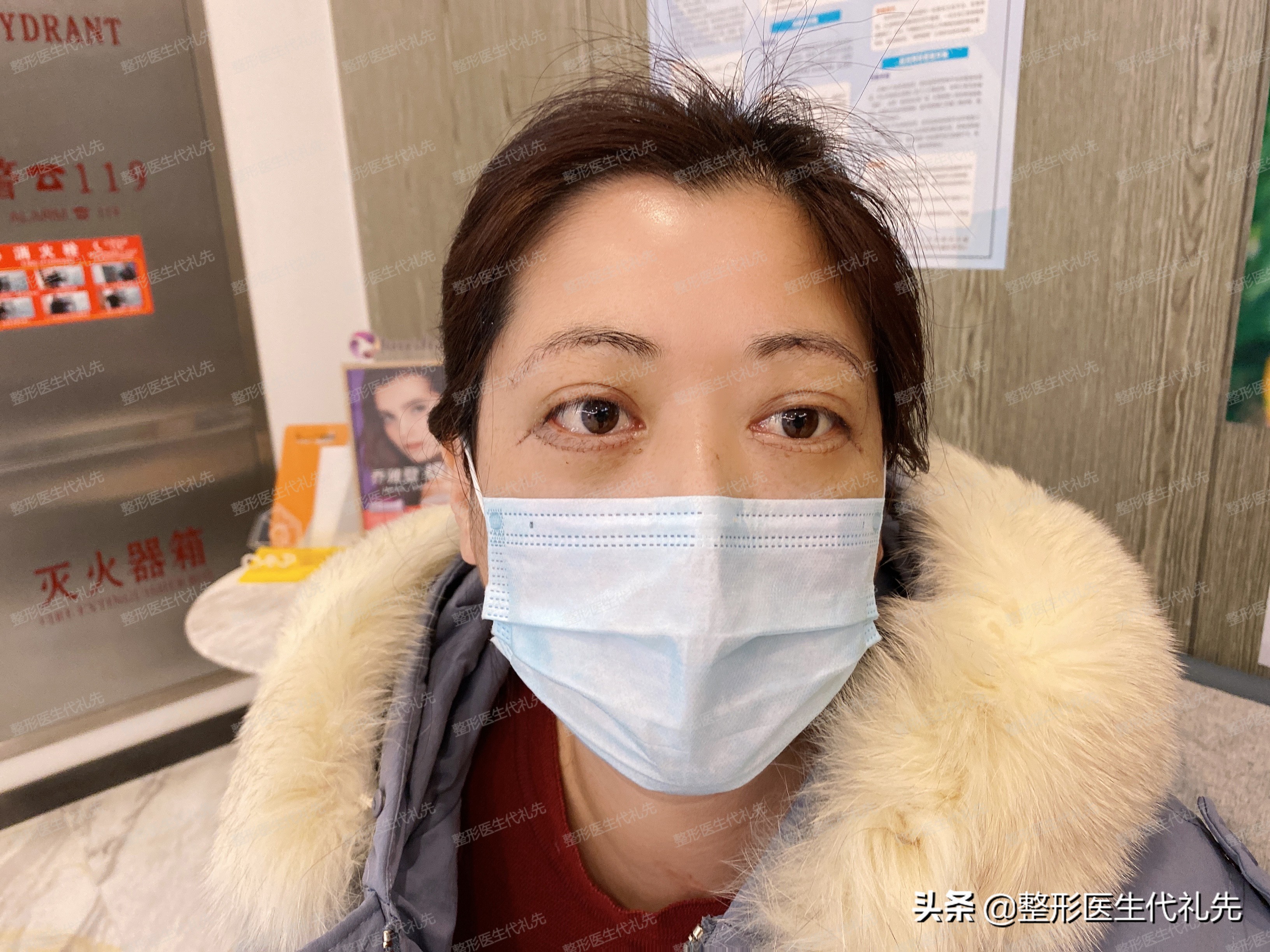 做提眉和外切眼袋恢复过程,提眉眼袋手术第9天