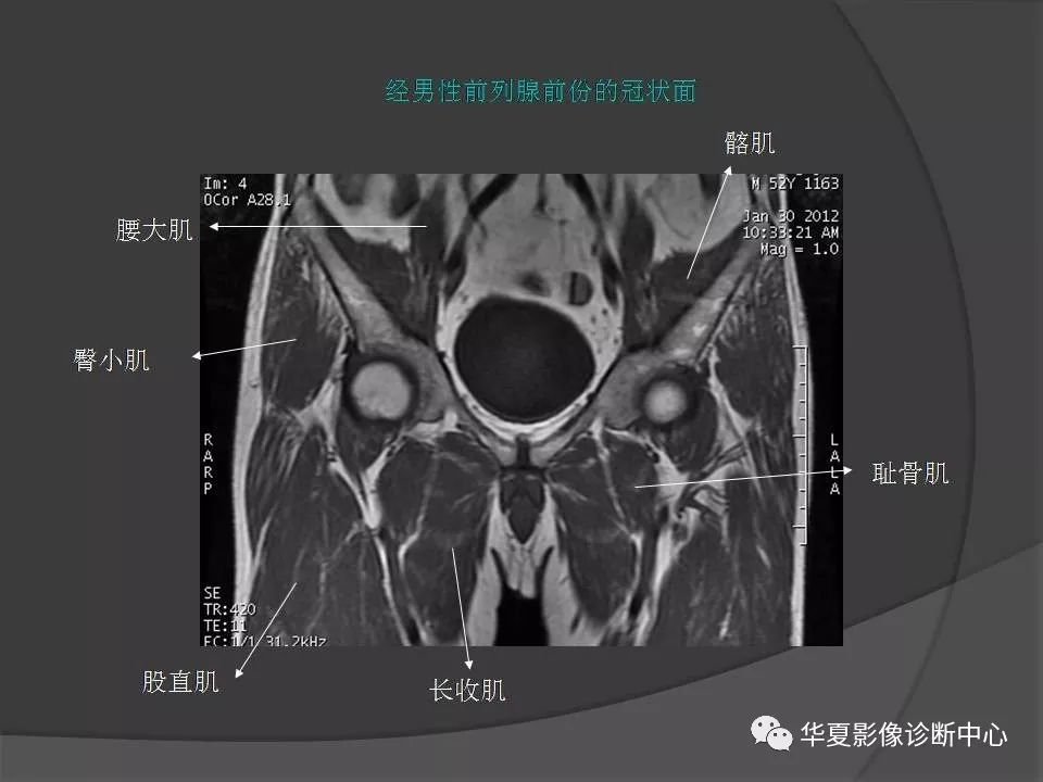 女性盆腔ct连续断层解剖图,盆腔mri影像病例分析