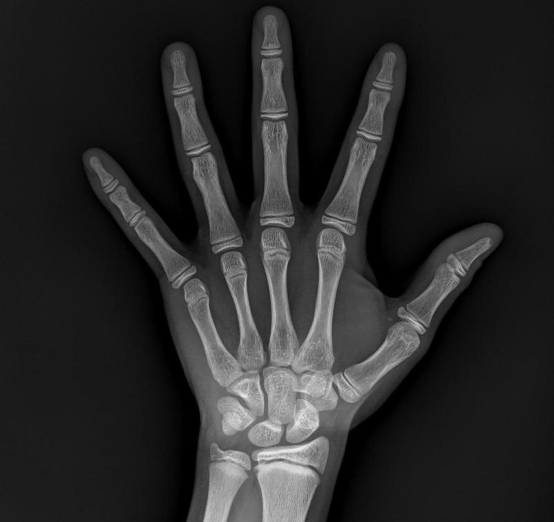 孩子骨龄偏大怎样才能让骨龄慢长,16岁孩子骨龄闭合如何长高