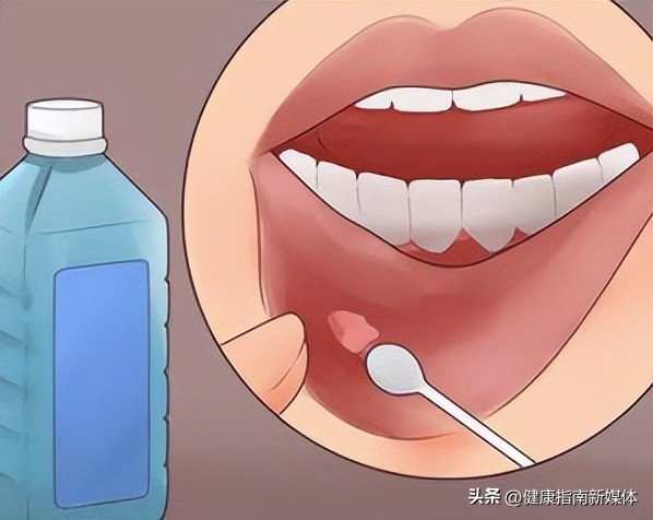 维c治疗口腔溃疡,如何治疗口腔溃疡口臭