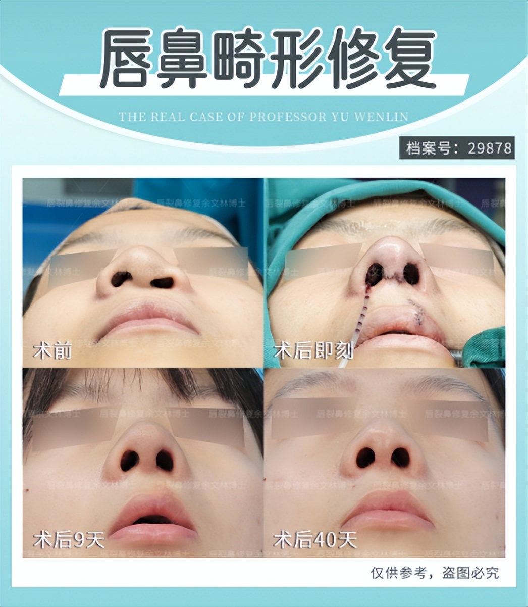 轻微唇裂可以完全修复好吗,唇裂做地包天矫正可以吗