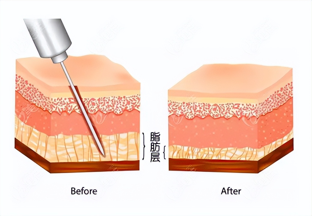 九院韦敏手术案例,九院整形科吸脂医生