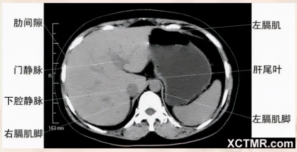 胸腹部盆腔ct主要检查什么,女性盆腔ct断层解剖结构图