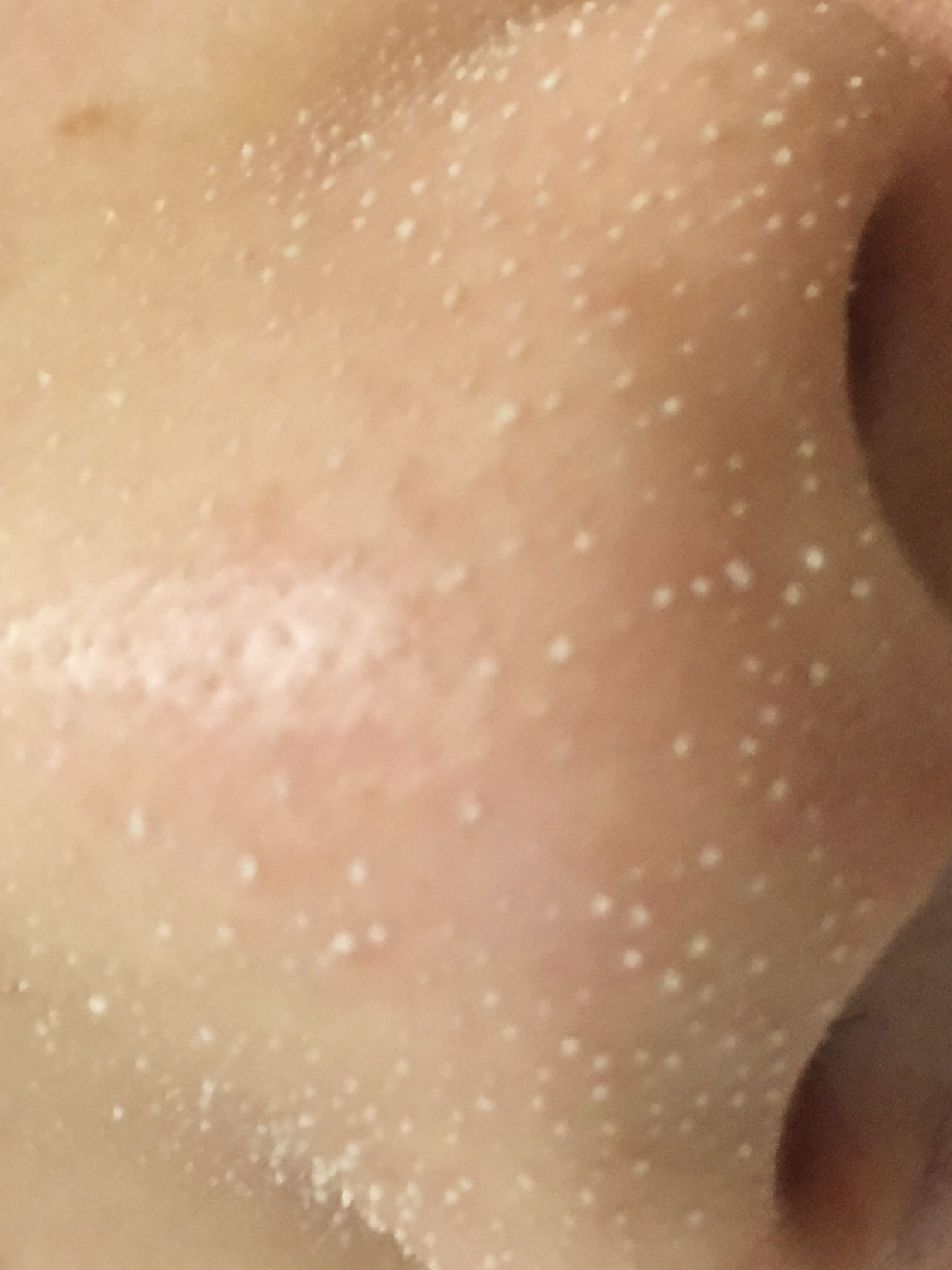 鼻子毛孔大能挤出好多脂肪粒,鼻子上长了像脂肪粒的东西