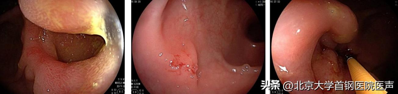 肠白塞病可以治疗好吗,肠白塞病能治愈吗
