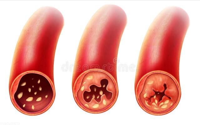 用于治疗冠心病活血化瘀的中成药 (治冠心病活血化瘀的中成药)