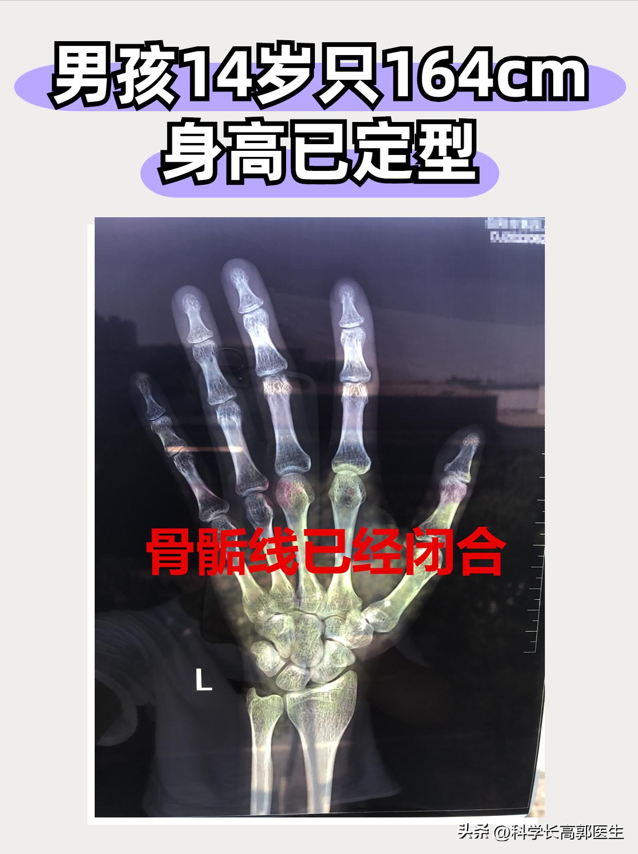 骨骺线闭合吃长高钙片有用吗,盲目补钙15岁男孩骨骺线提前闭合