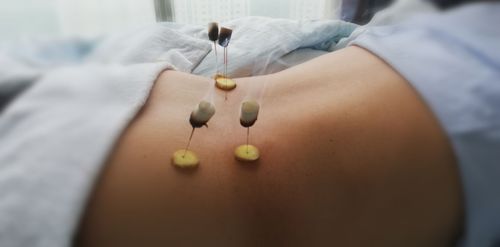 脾虚寒湿针灸能治好吗,针灸对脾虚型肥胖有用吗