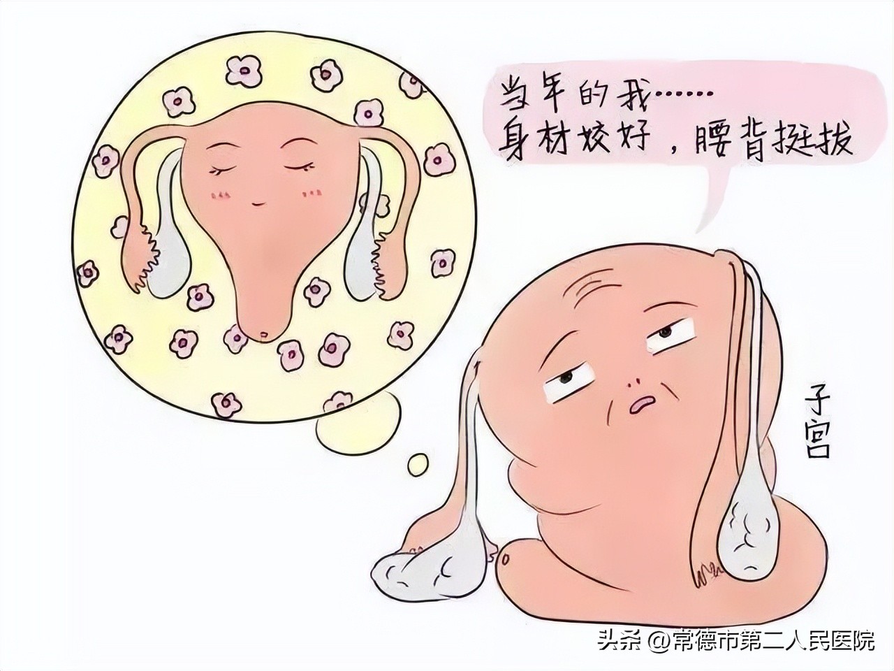 子宫脱垂掉出来一块肉,女性的难言之隐子宫脱垂