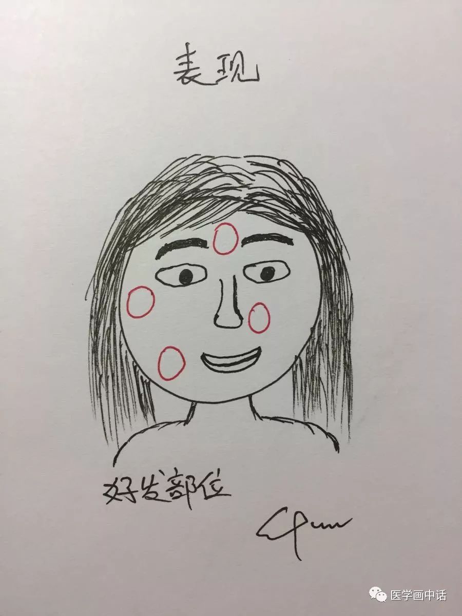 面部*褐斑黄**的诊断及治疗简析