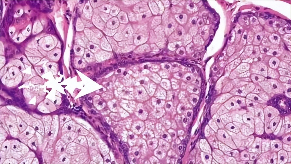脖子上长了小肉粒可以揪掉吗,脖子上长的小肉粒自己揪掉可以吗