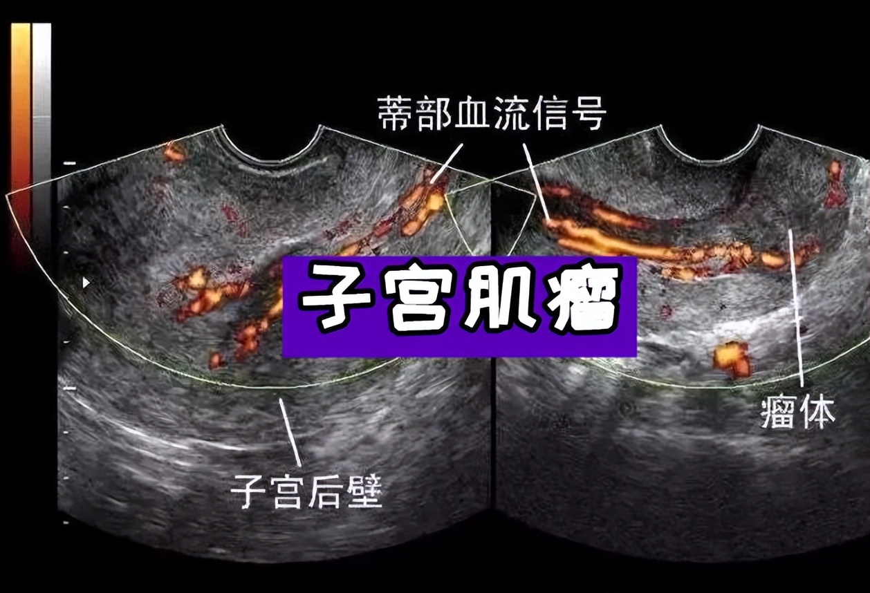 子宫肌瘤怎么解决是最好的,子宫肌瘤要怎么治才好得快