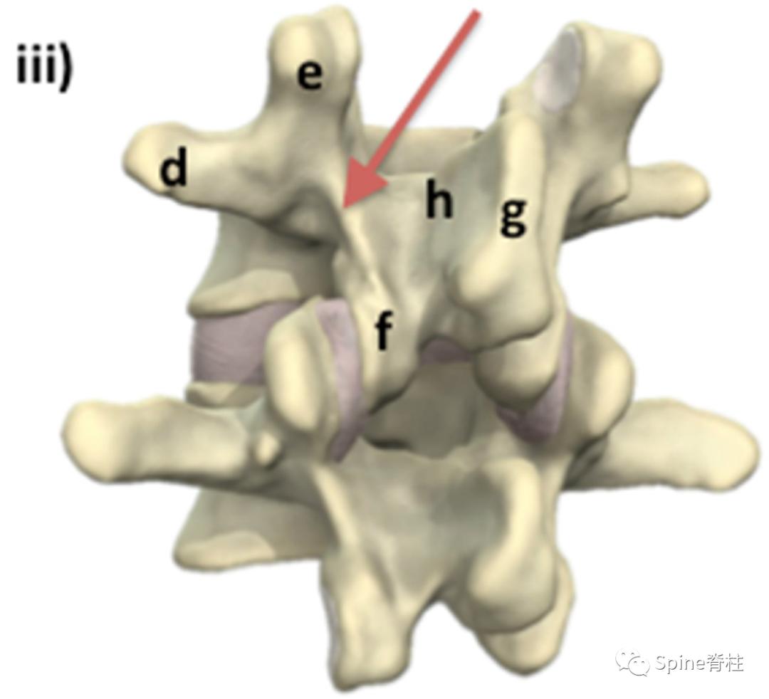 峡部裂和隐性峡部裂有区别吗,单纯峡部裂可以做峡部修复吗