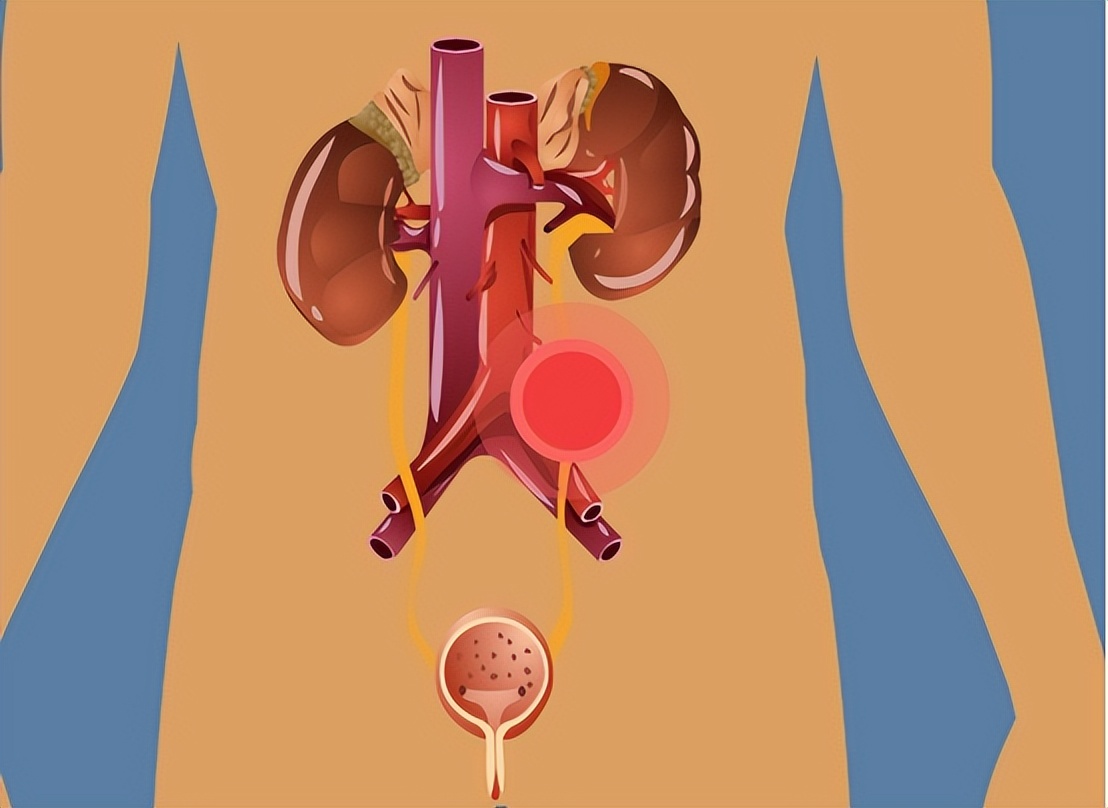 尿路感染自救方法,尿路感染怎样长期抑菌治疗