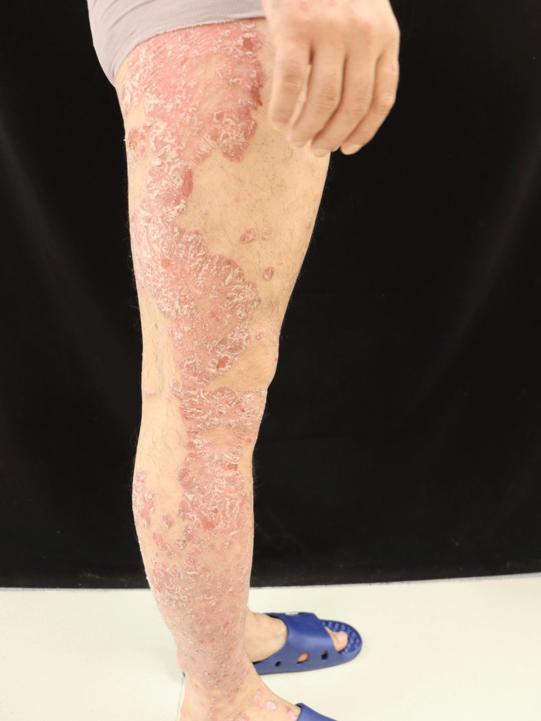 一睡醒，满床都是皮屑！“得了这病，剪发到一半就被赶出来”