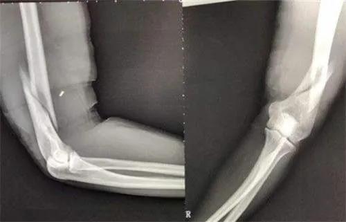 掰手腕如何防止骨头被掰断,掰手腕比赛只能用右手吗