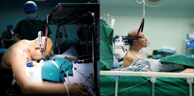 折叠人李华后续,折叠人李华四次手术完整版