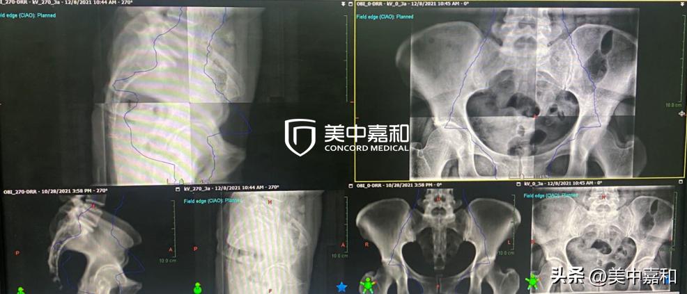 局部癌症,癌症晚期的奇迹案例