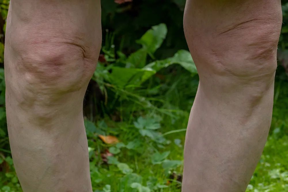 膝关节炎的保健与自我治疗,膝关节炎的保膝治疗