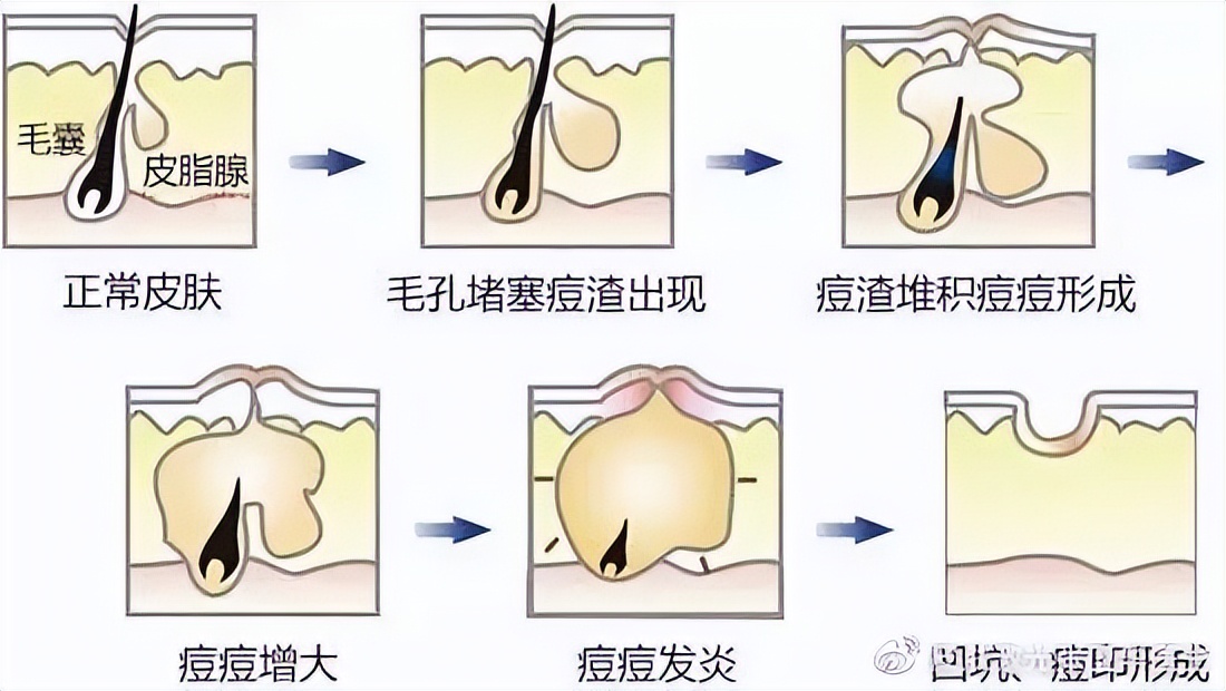 痘印痘坑要怎么去掉才能不留疤呢,为什么你脸上会长痘痘