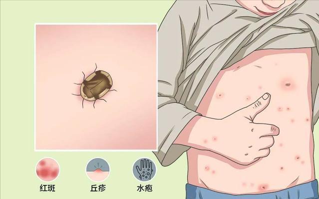 虫咬性皮炎的防治方法有哪些,去除顽固性虫咬皮炎的简单方法