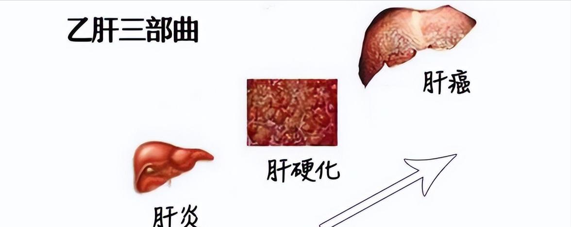 hbvdna阳性肝功能正常需治疗吗,30岁以上乙肝病毒dna阳性要治疗吗