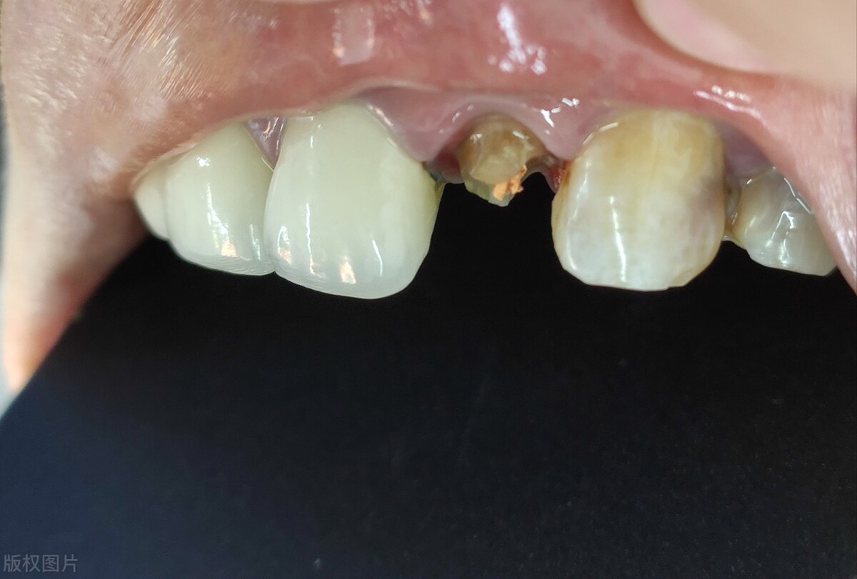 拔牙的危害有多大坏牙可以补吗,拔牙后不补的原因及危害