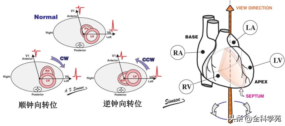 心电图笔记26：QRS波振幅变高，需要想到哪些
