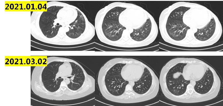乳腺癌晚期没多少钱怎么治疗最佳,经济困难癌症晚期可以放弃治疗吗