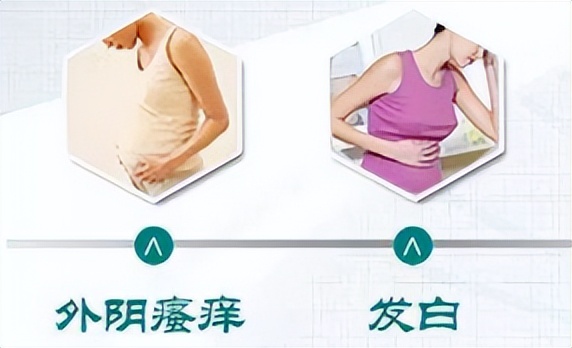 外阴瘙痒无比怎么办,外阴瘙痒可能是外阴白斑怎么止痒