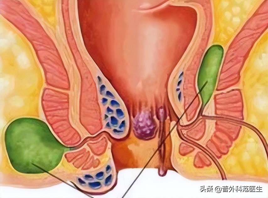 肛周脓肿疼痛难忍怎么办,得了肛周脓肿疼得死去活来