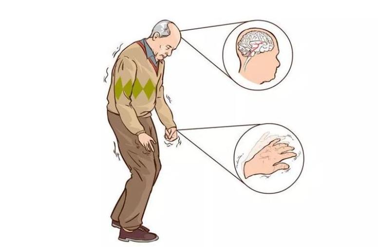 睡觉老是流口水是什么病的前兆,睡觉流口水是什么病的前兆