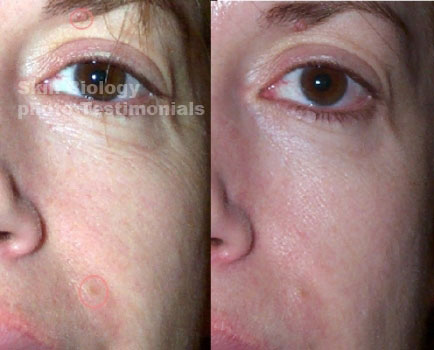 法令纹非常严重怎么消除,法令纹严重怎么处理比较好