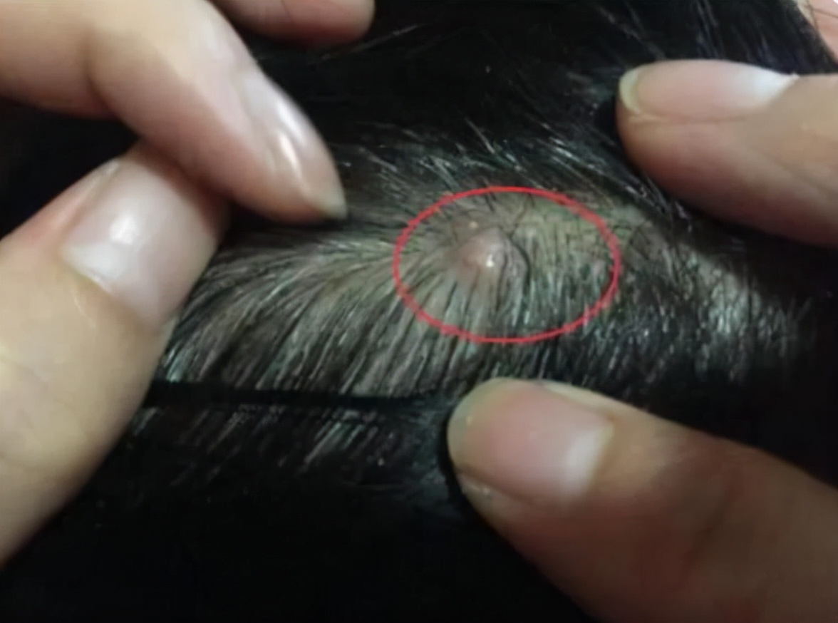 头皮有疙瘩脓包痒痒用什么药,头皮起红色小疙瘩有脓包怎么治