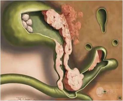 胆囊炎胆囊结石怎么办,胆囊结石最佳处理方法