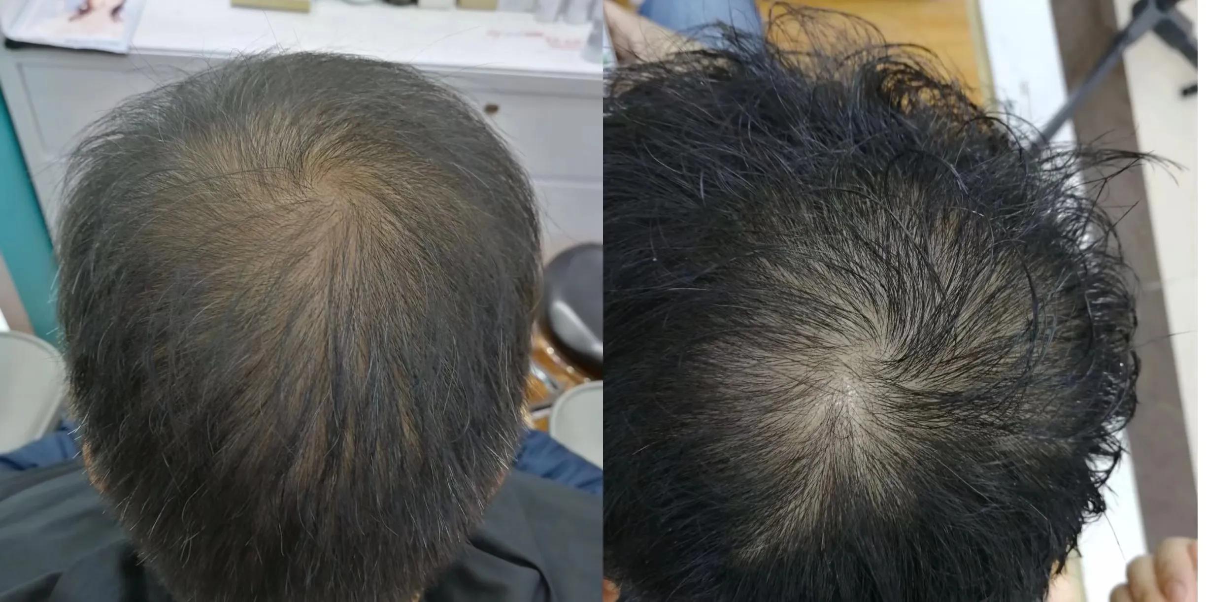 头顶漩涡处头发稀少怎么办,15岁头顶漩涡处头发稀少