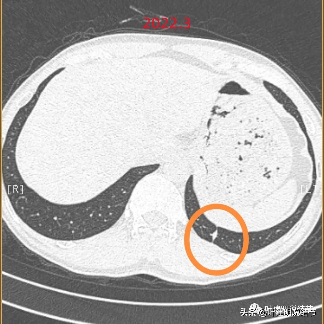 有关肺部结节的知识,医生判定存在风险的肺结节