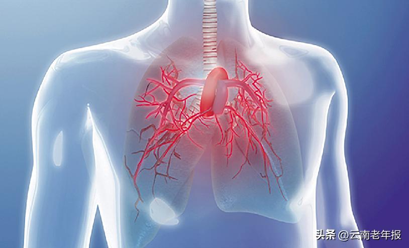 肺动脉高压患者如何进行日常管理,肺动脉高压平时怎么保养比较好