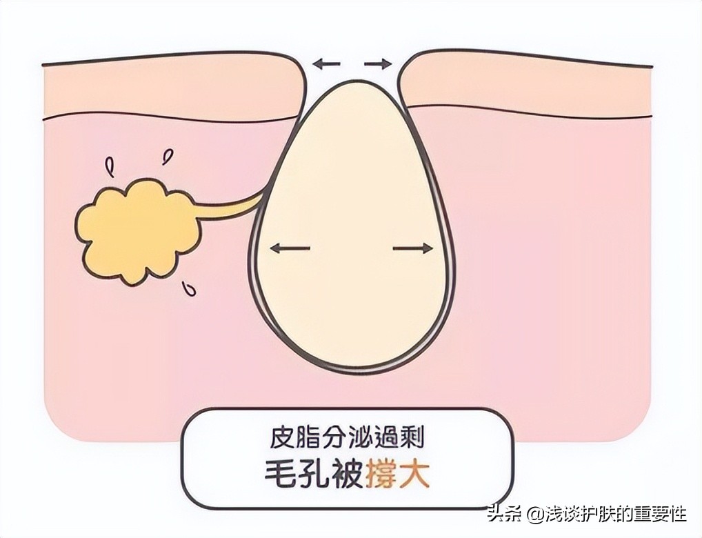 毛孔粗大收缩毛孔最有效果的方法,毛孔粗大收缩毛孔最快有效的方法