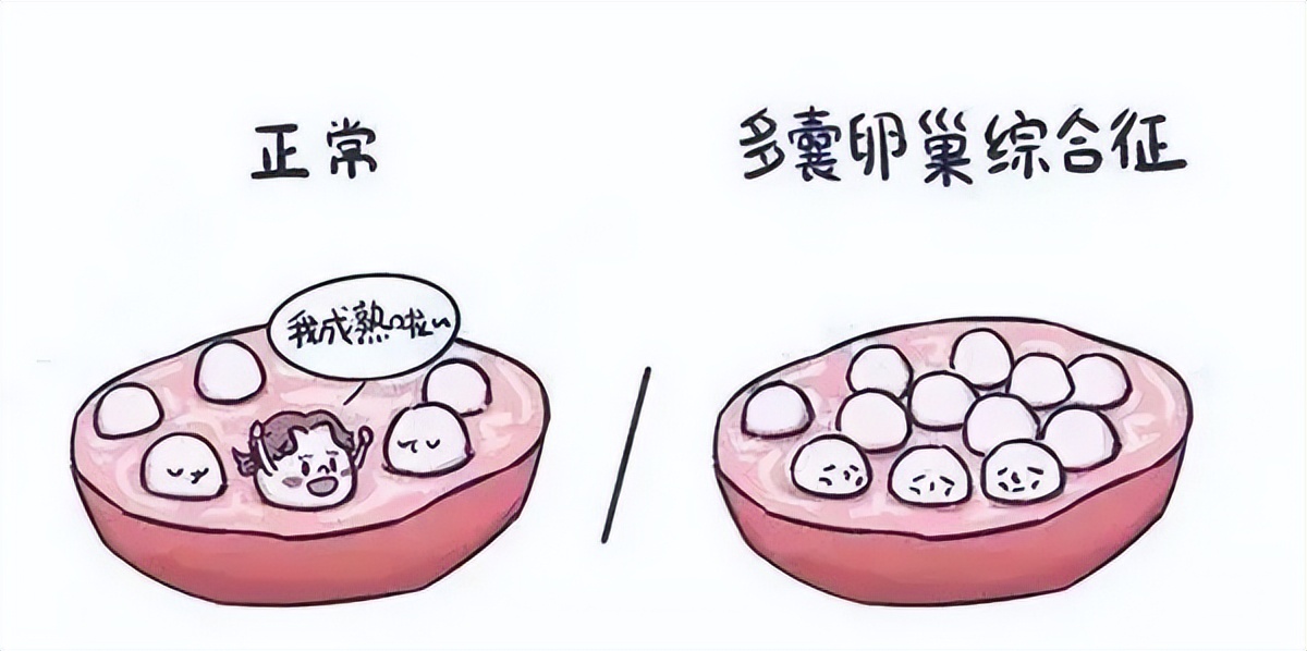 多囊卵巢发病率高吗,多囊卵巢综合征发病率是多少