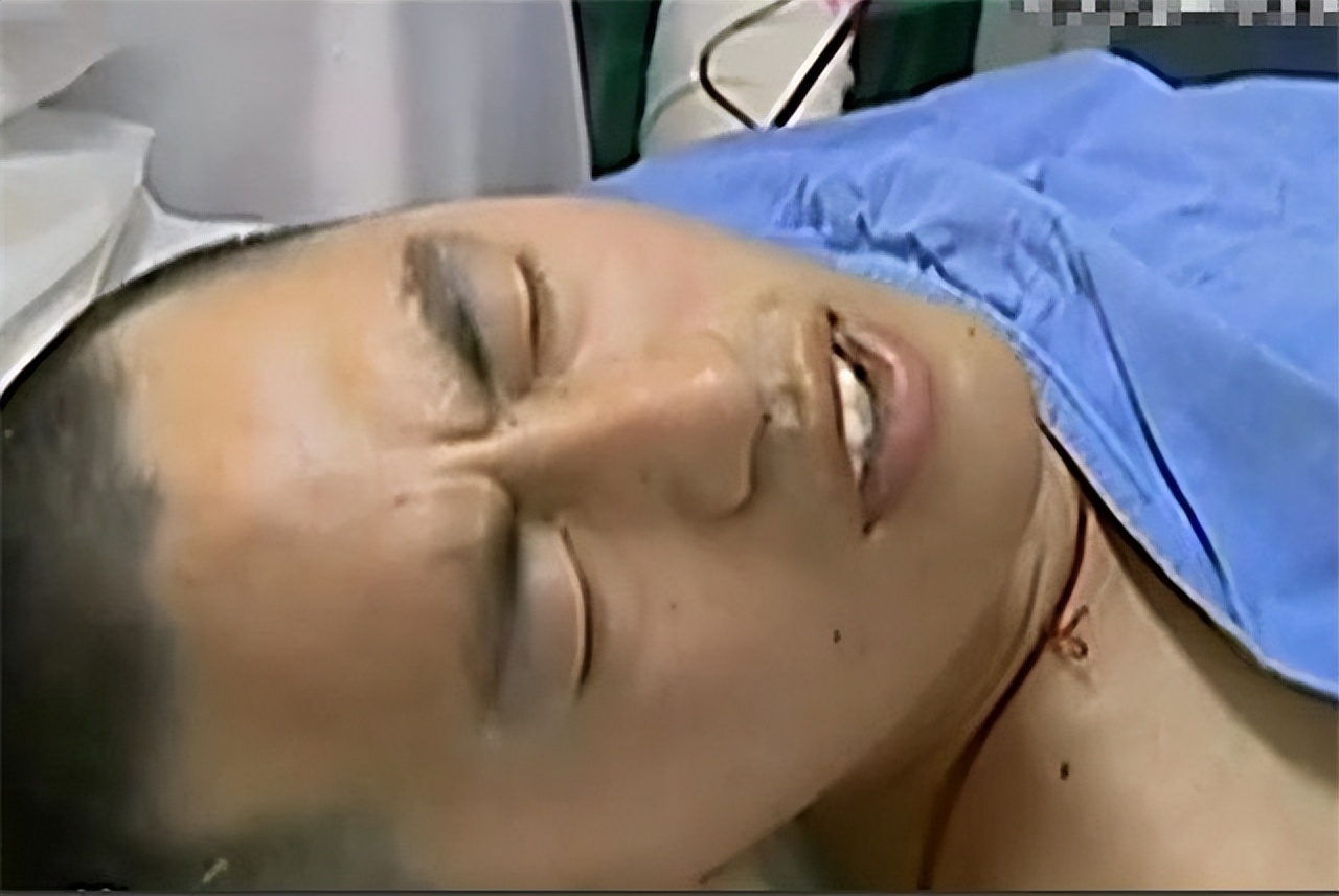 男子意外烧伤用蛆来治疗后续,小伙双腿被烧伤医生用蛆治疗