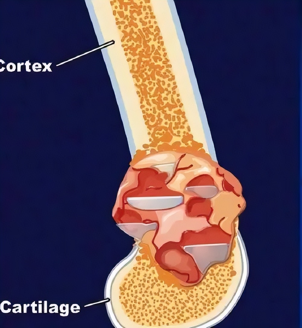 12岁男孩右臂莫名疼痛，为了保命无奈截肢，谁知更大悲剧袭来