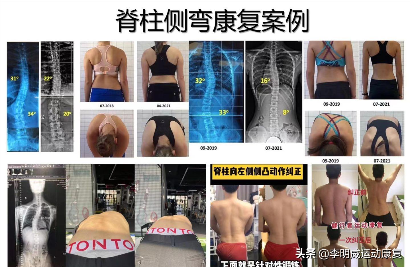 14岁男孩脊柱侧弯怎么训练,14岁女孩脊柱侧弯以后还会加重吗