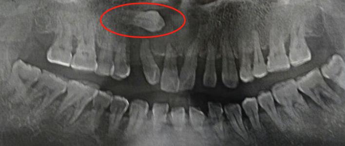 牙齿长小牙该怎么拔掉,牙齿长在上颌窦里了能拔吗