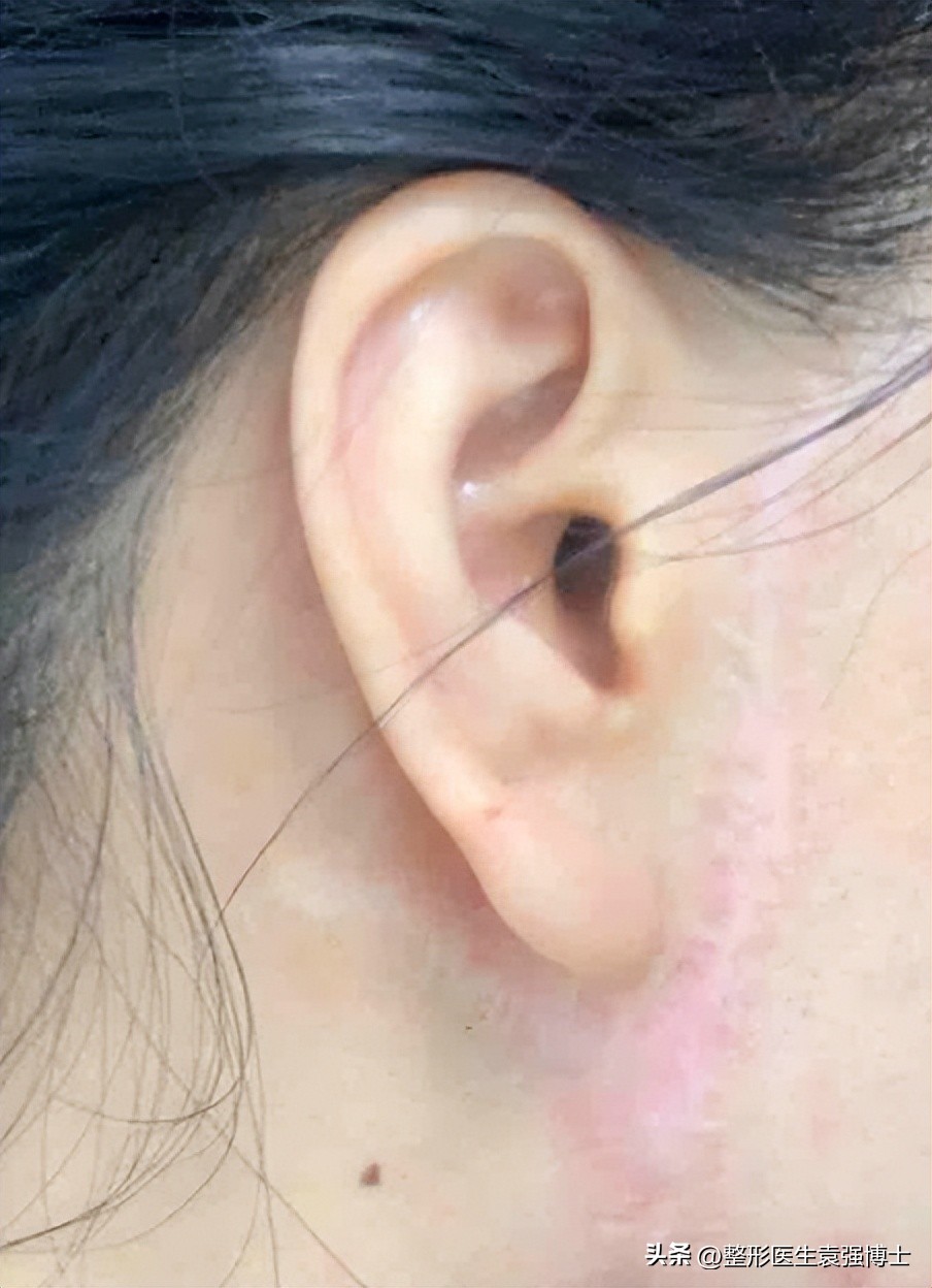 拉皮手术是整形的终极选择吗,整形大拉皮一般多少价格