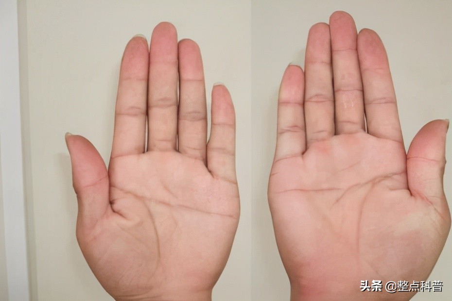 民间断掌纹说法,断掌纹与先天疾病